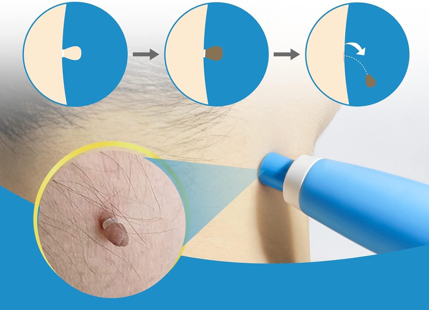Kit de suppression indolore de - Health Wellness avis et prix